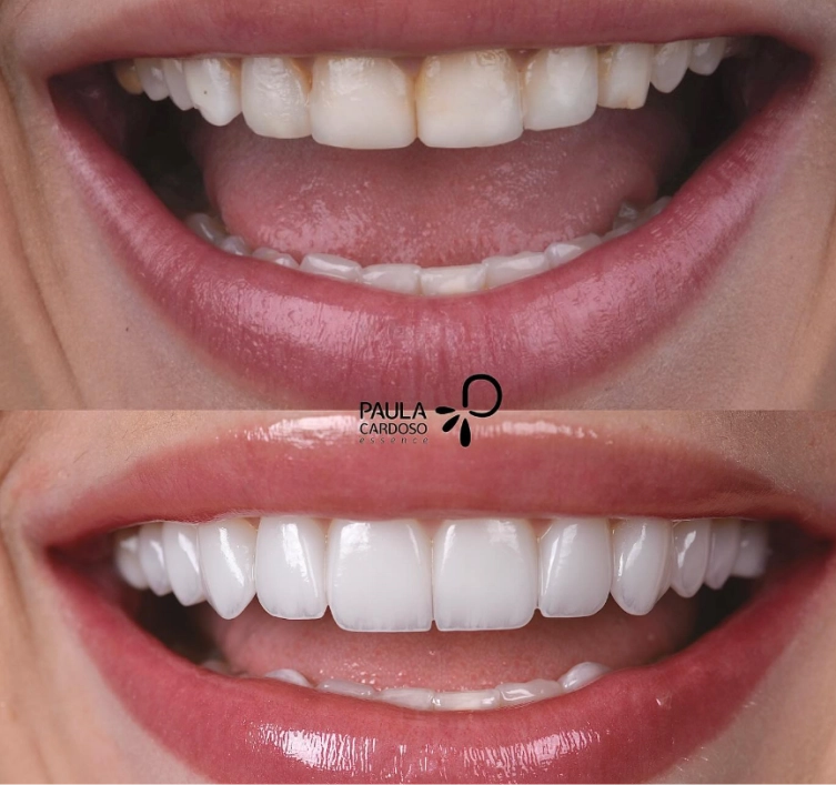 Resultado de transformação estética do sorriso 1