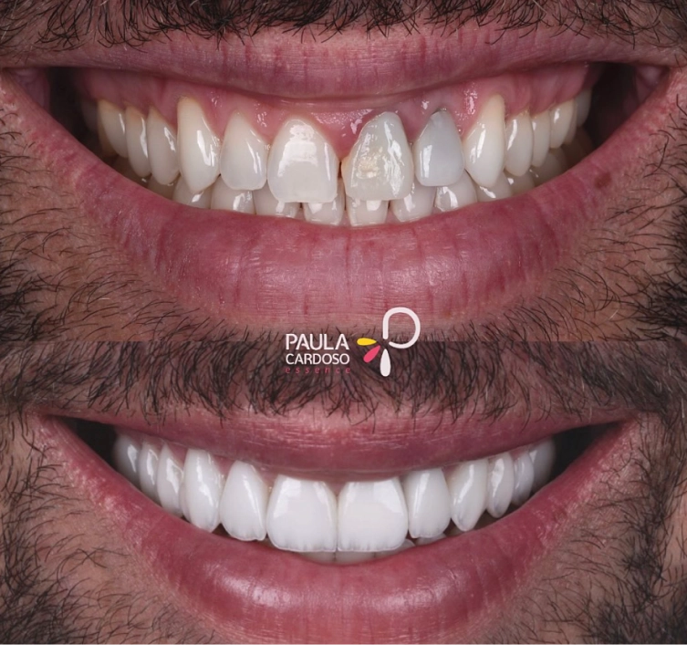 Resultado de transformação estética do sorriso 2