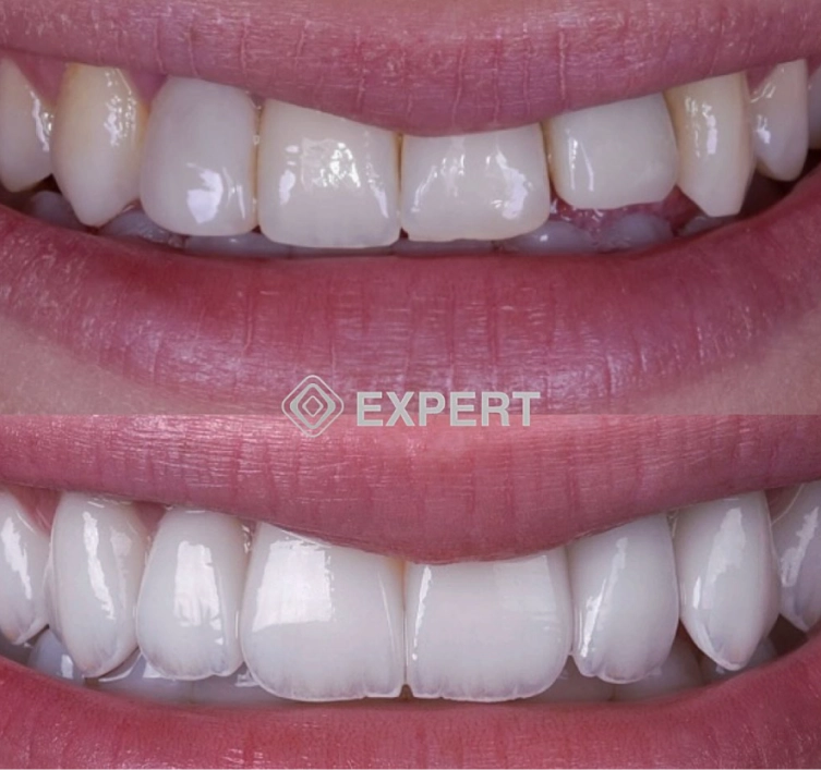 Resultado de transformação estética do sorriso 3
