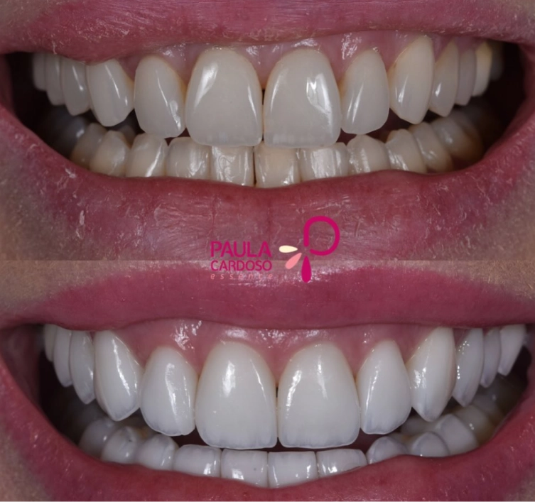 Resultado de transformação estética do sorriso 4