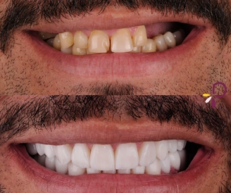 Sorriso após tratamento estético odontológico